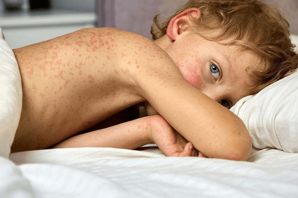 a blonde child lying in bed on their side, with their arm partially covering their face. A red rash is visible on their back.