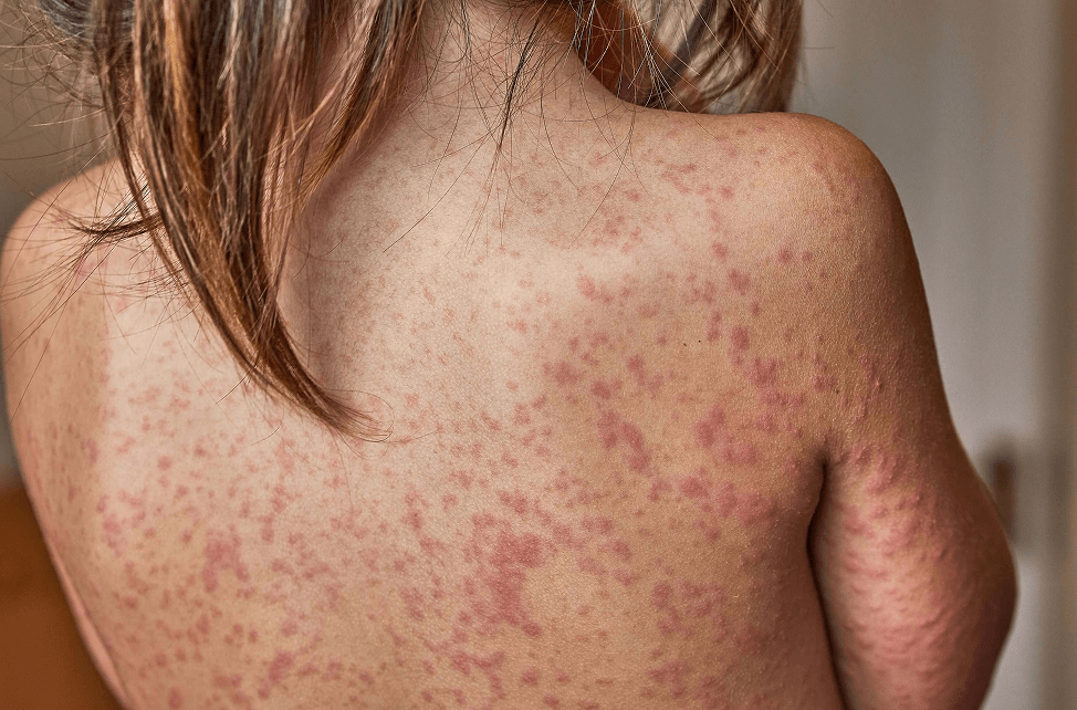 What is Measles? 