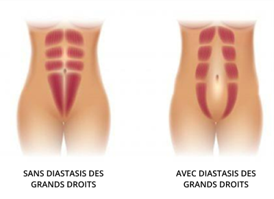Une image mettant en apposition les muscles abdominaux « normaux » et le diastasis des grands droits. L’image de droite montre la séparation des muscles au milieu de l’abdomen