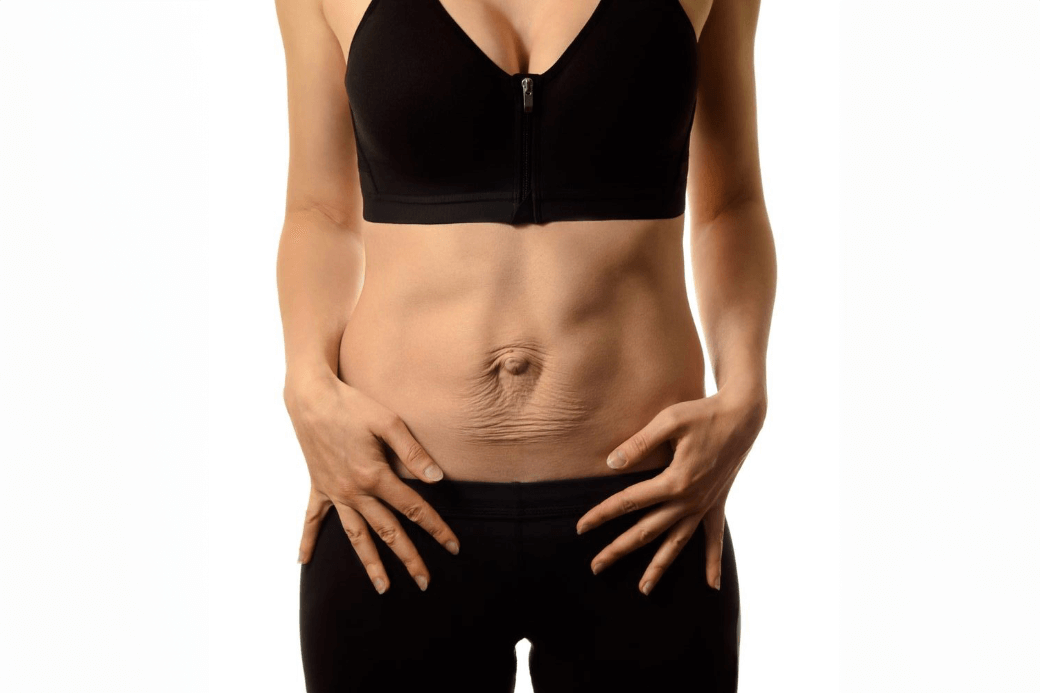 What is Diastasis Recti? And can I still exercise?